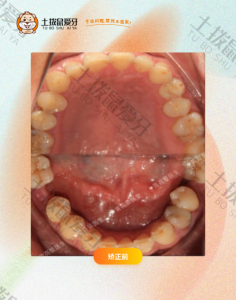男子深覆颌+缺牙正畸案例
