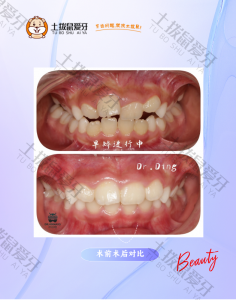 早期矫正牙齿扭转拥挤