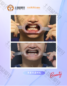 深覆颌非拔牙隐形矫正