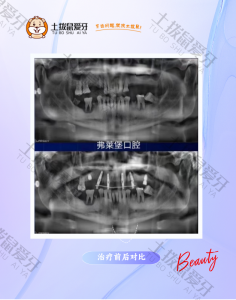 半口即刻负重当天戴牙案例