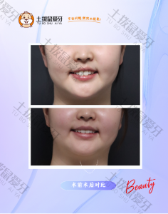 深覆盖非拔牙隐形矫正案例