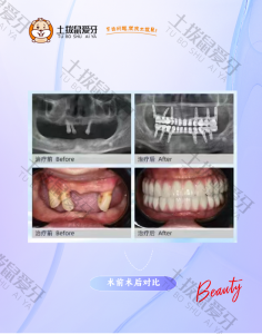 高龄全口缺失种植修复