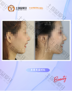 深覆颌矫正“送下巴”案例