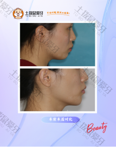 牙凸下巴后缩矫正案例