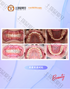15岁前牙III度深覆合，矫正案例