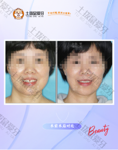 42岁女士牙列稀疏矫正