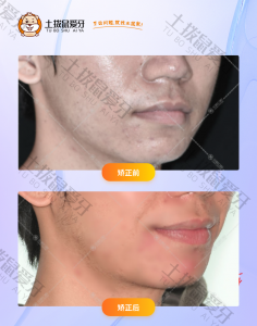 男士牙齿拥挤，门牙有缝隙