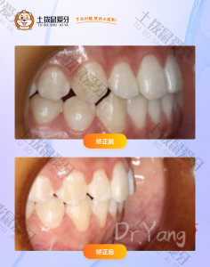 患者骨偏斜正畸正颌联合治疗
