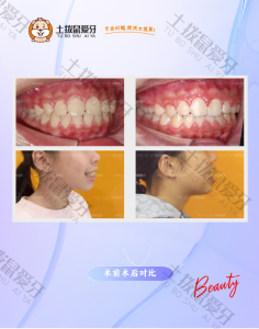 青少年牙列稀疏有缝隙矫正