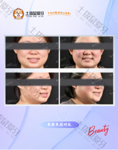 开颌咬合不齐矫正