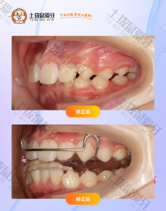 男生上颌牙齿重度深覆盖，牙齿不齐正畸案例