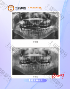 下牙列中度拥挤,上牙弓狭窄矫正