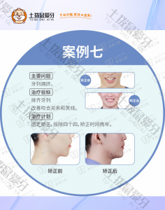 先生牙列拥挤，微笑不佳正畸案例