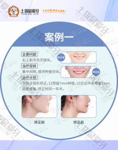女生右上前牙先天缺失，种植联合正畸