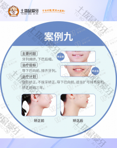 女生牙列拥挤，下巴后缩矫正案例