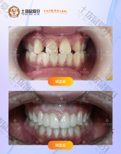 李小姐牙齿稀疏矫正案例
