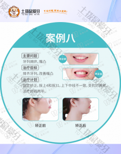 女生牙列拥挤，嘴凸矫正案例