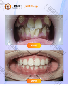 冯女士牙列拥挤，非常影响美观，患者反馈社交不自信，不敢开口说话，要求隐形矫正