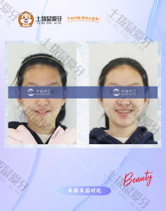 上突下缩矫正案例