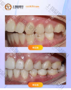 患者牙齿开合，牙列不齐