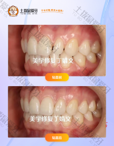 患者侧切牙缝比较大贴面案例