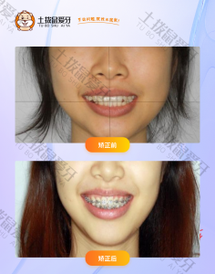 女士牙齿中线不齐，牙列不齐矫正案例