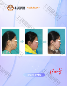 10岁女童反颌地包天牙列拥挤矫正