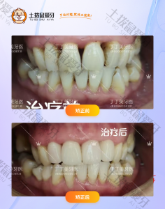 患者牙缝较大，牙龈有很多黑三角