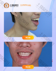 嘴凸龅牙，牙齿拥挤正畸案例