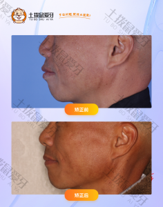 先生牙齿不齐，侧面突嘴型正畸案例