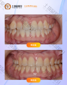 女士牙齿轻度拥挤，中线不齐