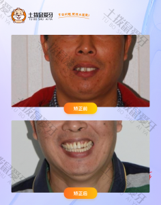 先生牙齿不整齐，牙齿松动，牙周病正畸案例