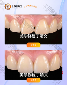 患者门牙畸形，缺损贴面案例
