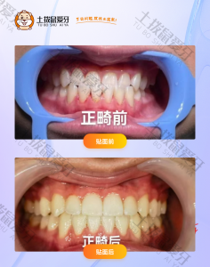 患者下颌牙齿反颌，地包天案例