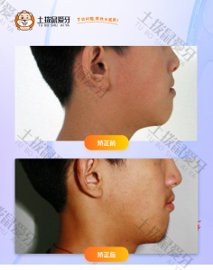 男生骨性反合高角患者策略性矫治