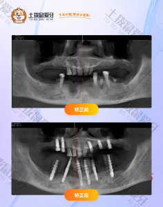 先生全口多数牙齿缺失种植案例
