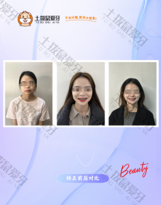 嘴突牙突金属托槽矫正