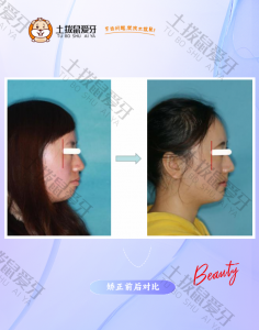 23岁女上下牙列拥挤不齐，双牙弓前突