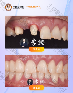 患者前牙多颗牙种植修复案例