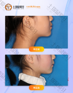 女生颌骨骨性3类错颌畸形，下颌牙列紊乱