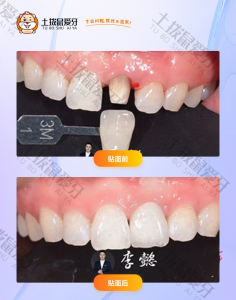 患者前牙单颗修复