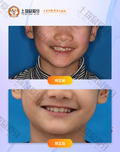 青少年骨性2类，阻生牙深覆合
