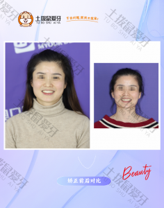 35岁女性安氏2类一分类牙列拥挤矫正