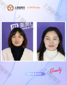 隐适美矫正牙列不齐（女）32岁