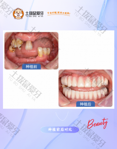 全口即刻种植