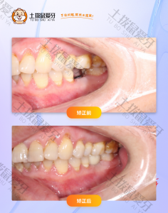 38岁女士，单颗牙缺失
