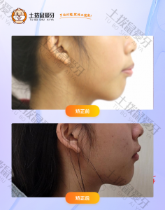 7岁女孩牙齿不齐，门牙前突，下颌严重后缩