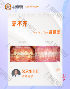 患者牙弓狭窄，牙齿拥挤，个别牙反颌正畸案例