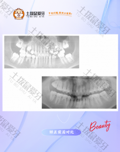 埋伏牙牵引经典案例