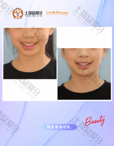 中度拥挤不拔牙矫正